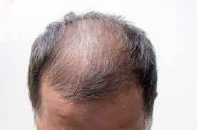 using minoxidil for hair loss
