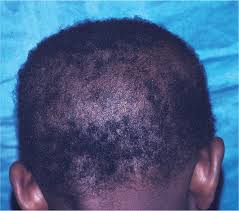 That these bumps are infected or raised hair follicles. Hair Loss Common Causes And Treatment American Family Physician