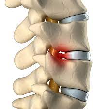 slipped disc causes symptoms
