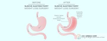 laparoscopic sleeve gastrectomy g l