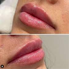 how long does juvéderm last in lips