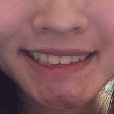 how to fix left lower lip that cannot