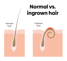 ingrown hairs symptoms causes and how