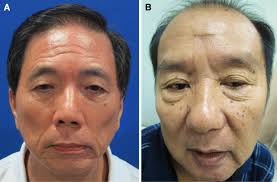 forehead lipoma excision a comparative