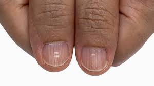 psoriatic arthritis nails nail