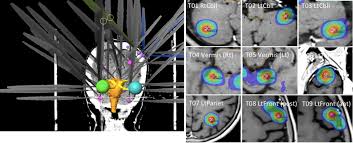 dosimetric study of automatic brain