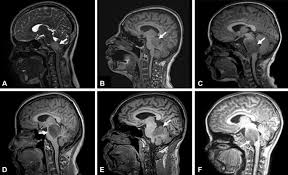 brainstem tumors may increase the