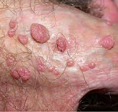 warts symptoms shim clinic