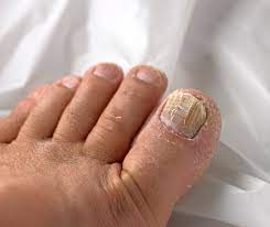 dry brittle toenails caused by toenail