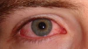 pink eye vs stye differences causes