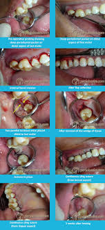 periodontal flap surgeries cur