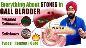 rx gallstones 2 eng lose weight fast