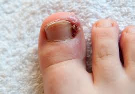 ingrown toe nails singhania skin clinic