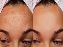 Know the reason of Pimples on Forehead and ways to get rid of it - Pimples  on Forehead: माथे पर आ जाते हैं मुंहासे? जानिए कारण और छुटकारा पाने के तरीके
