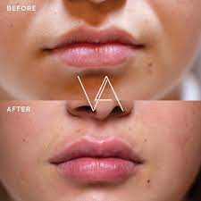 london lip fillers lip injections