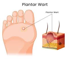 how to get rid of plantar warts for