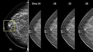 Breast Tomosynthesis Better Than Mammography