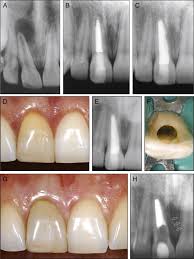 recur apical periodonis and late
