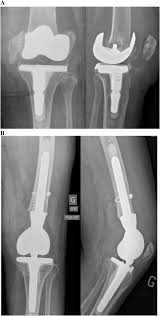 total knee arthroplasty with distal