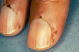 1 nailfold vasculitis in a patient with