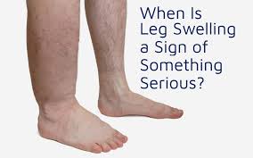 when is leg swelling a sign of