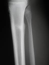 tibial shaft stress fractures knee