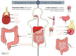 Differences Between Crohns And Colitis Qu Ibd