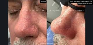 vbeam laser nyc before and after