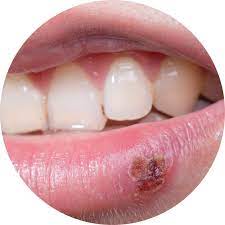 cold sore or canker sore total care