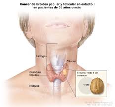 Sin embargo, con frecuencia es familiar y se debe a una mutación del. Tratamiento Del Cancer De Tiroides En Adultos Pdq Version Para Pacientes Instituto Nacional Del Cancer