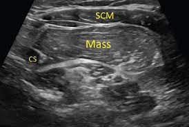 ultrasound of the soft tissues of the