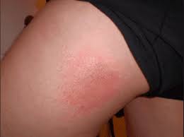 thigh sweat rash how to prevent