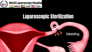 video lecture on laparoscopic sterilization