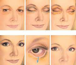 plastic surgery of eyelids latvijas