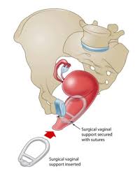 surgical pelvic organ pessary s pop