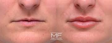 lip fillers before after photo