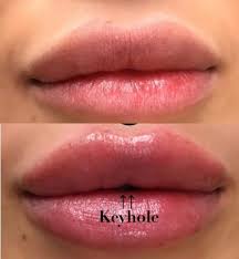 keyhole pout lip injection phoenix