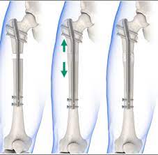 cosmetic limb lengthening athens bjr