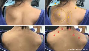 trigger point injections in southlake