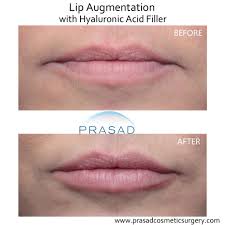how to avoid bad lip filler results