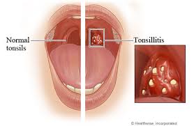 Hasil gambar untuk TONSILITIS HELLO SEHAT