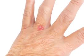 types of bug bites symptoms and treatments