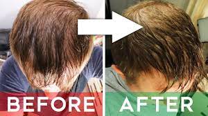finasteride review does it cure hair