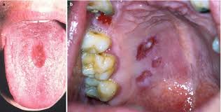 bacterial infections of the mucosa
