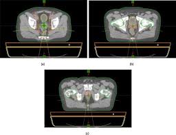 proton therapy planning and image