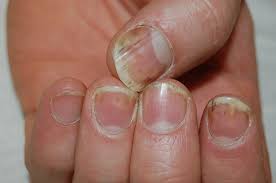 nail bed psoriasis of fingernails
