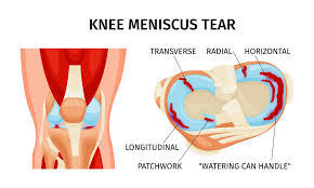orion meniscus surgery