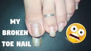 my broken toe nail diy toe nail care