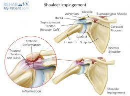 shoulder impingement syndrome rehab