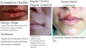 chapped lips lips lesion types